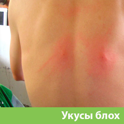 Укусы блох в Волжском