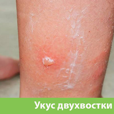 Укус двухвостки в Волжском