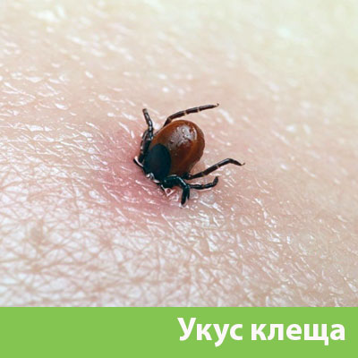 Укус клеща в Волжском
