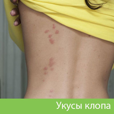 Профессиональное уничтожение клопов в Волжском